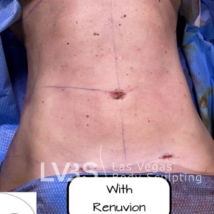 Liposuction Before & After Patient #663