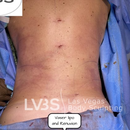 Liposuction Before & After Patient #663
