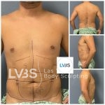 Liposuction Before & After Patient #682