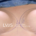 Breast Augmentation Before & After Patient #717