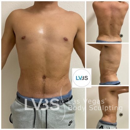 Liposuction Before & After Patient #682