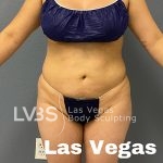 Liposuction Before & After Patient #685