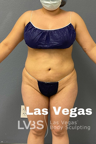 Liposuction Before & After Patient #685