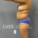 Liposuction Before & After Patient #688