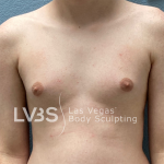Gynecomastia Before & After Patient #668