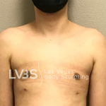 Gynecomastia Before & After Patient #668