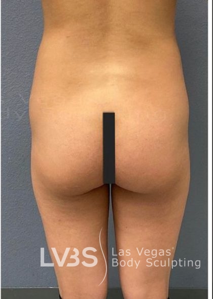 Liposuction Before & After Patient #787
