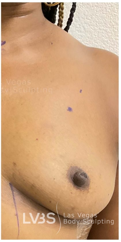 Breast Augmentation Before & After Patient #804
