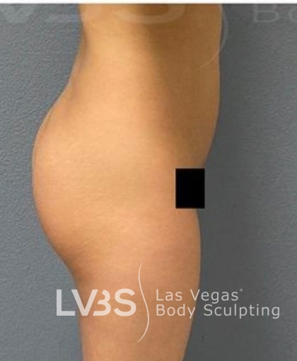 Liposuction Before & After Patient #787