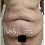 Liposuction Before & After Patient #812