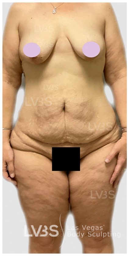 Tummy Tuck Before & After Patient #817