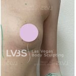 Breast Augmentation Before & After Patient #820