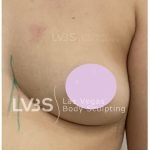 Breast Augmentation Before & After Patient #823