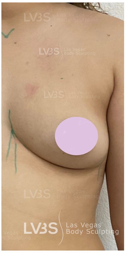 Breast Augmentation Before & After Patient #823