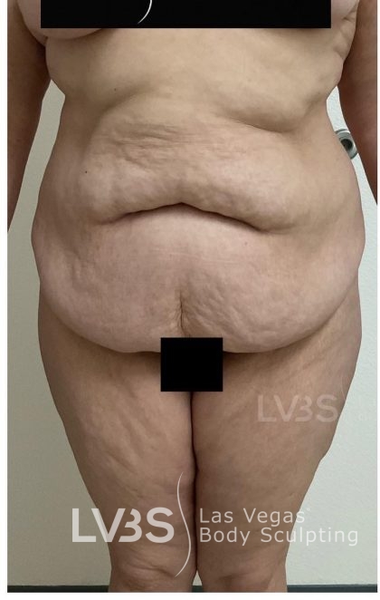 Brazilian Butt Lift (Fat Transfer to Butt) Before & After Patient #832