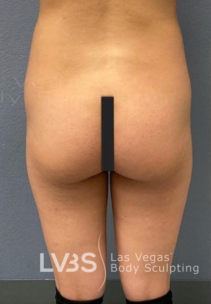 Brazilian Butt Lift (Fat Transfer to Butt) Before & After Patient #837