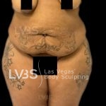 Liposuction Before & After Patient #809