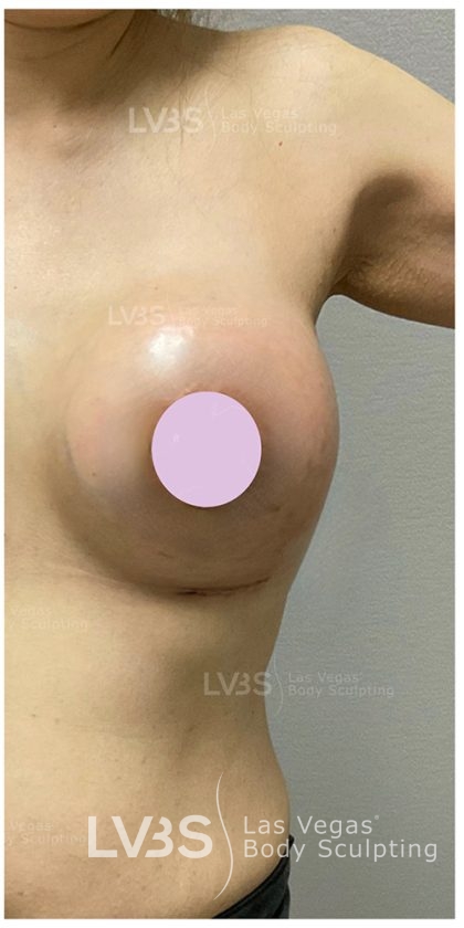 Breast Augmentation Before & After Patient #820