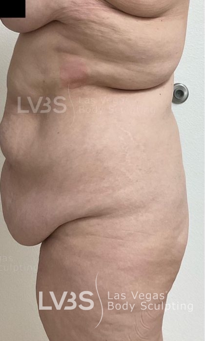 Brazilian Butt Lift (Fat Transfer to Butt) Before & After Patient #832