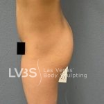 Brazilian Butt Lift (Fat Transfer to Butt) Before & After Patient #837