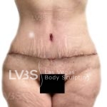 Liposuction Before & After Patient #826