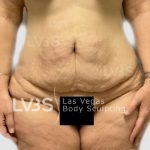 Liposuction Before & After Patient #826
