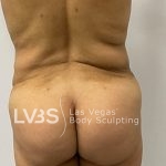Brazilian Butt Lift (Fat Transfer to Butt) Before & After Patient #844