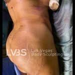 Brazilian Butt Lift (Fat Transfer to Butt) Before & After Patient #844