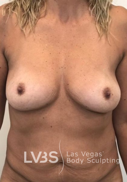 Breast Lift Before & After Patient #1072
