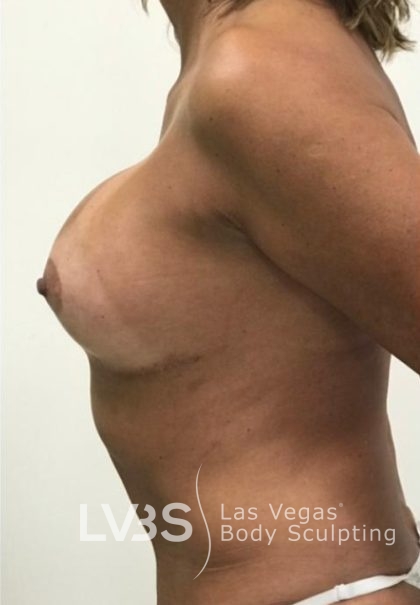 Breast Lift Before & After Patient #1072