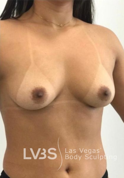 Breast Lift Before & After Patient #1073