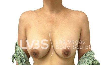 Breast Implants Exchange Before & After Patient #1101