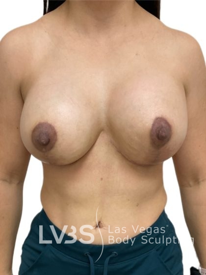 Breast Implant Before & After Patient #1096