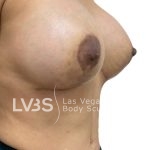 Breast Implant Before & After Patient #1096