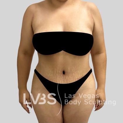 Tummy Tuck Before & After Patient #1130