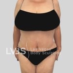 Tummy Tuck Before & After Patient #1131