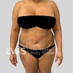 Tummy Tuck Before & After Patient #1132