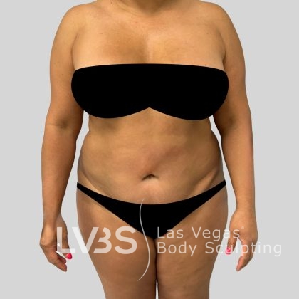 Tummy Tuck Before & After Patient #1132