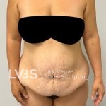 Tummy Tuck Before & After Patient #1129