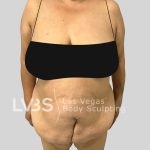 Tummy Tuck Before & After Patient #1131