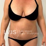 Tummy Tuck Before & After Patient #1133