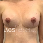 Breast Lift Before & After Patient #1071