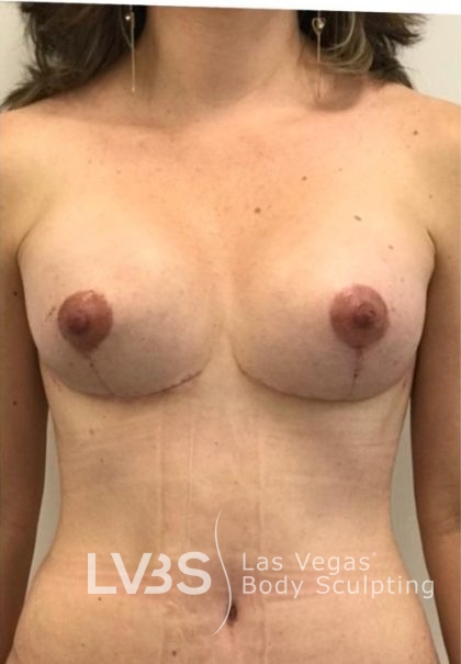 Breast Lift Before & After Patient #1071